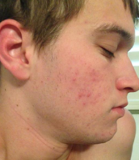 acne+before